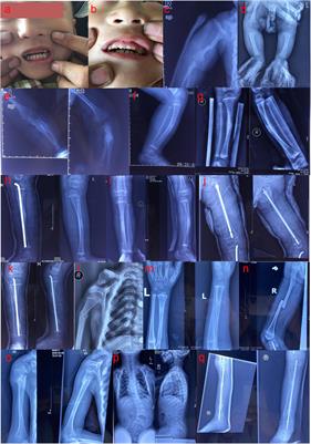 Genetic Analysis and Functional Study of a Pedigree With Bruck Syndrome Caused by PLOD2 Variant